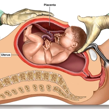 Caesarean Section