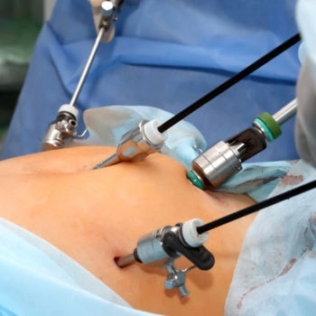 Laparoscopic Surgery